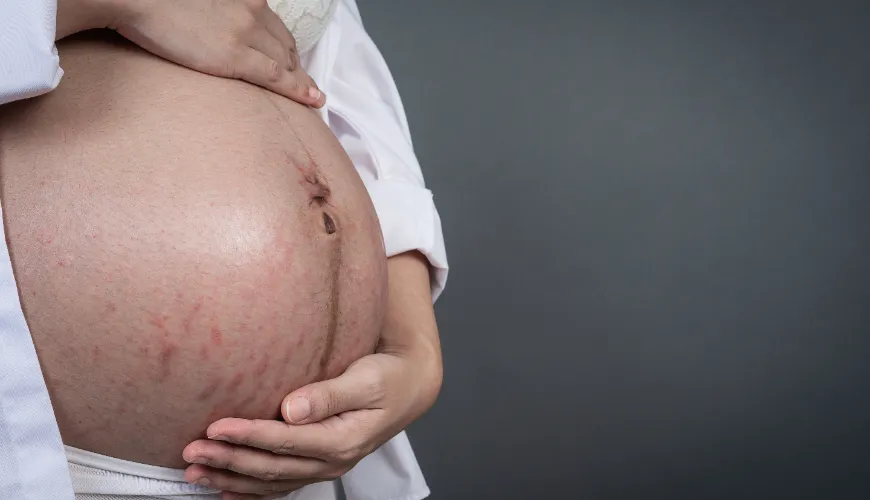 Moyens naturels de lutter contre l'acné pendant la grossesse